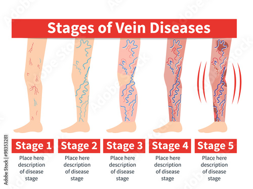 Vector Varicose infographic. Stage of vein diseases. Medical infographic.