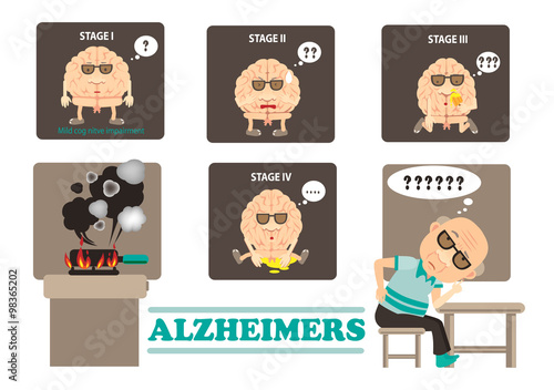 Stages of Alzheimers dementia  disease  info graphics.vector illustration