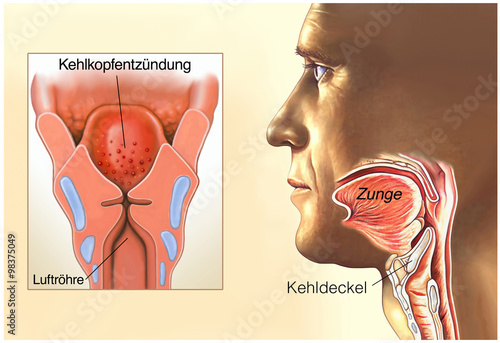 Kehlkopfentzündung photo