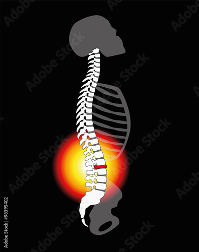 Back pain - spinal disc herniation or prolapse at a human vertebral column - profile view. Vector illustration on black background.