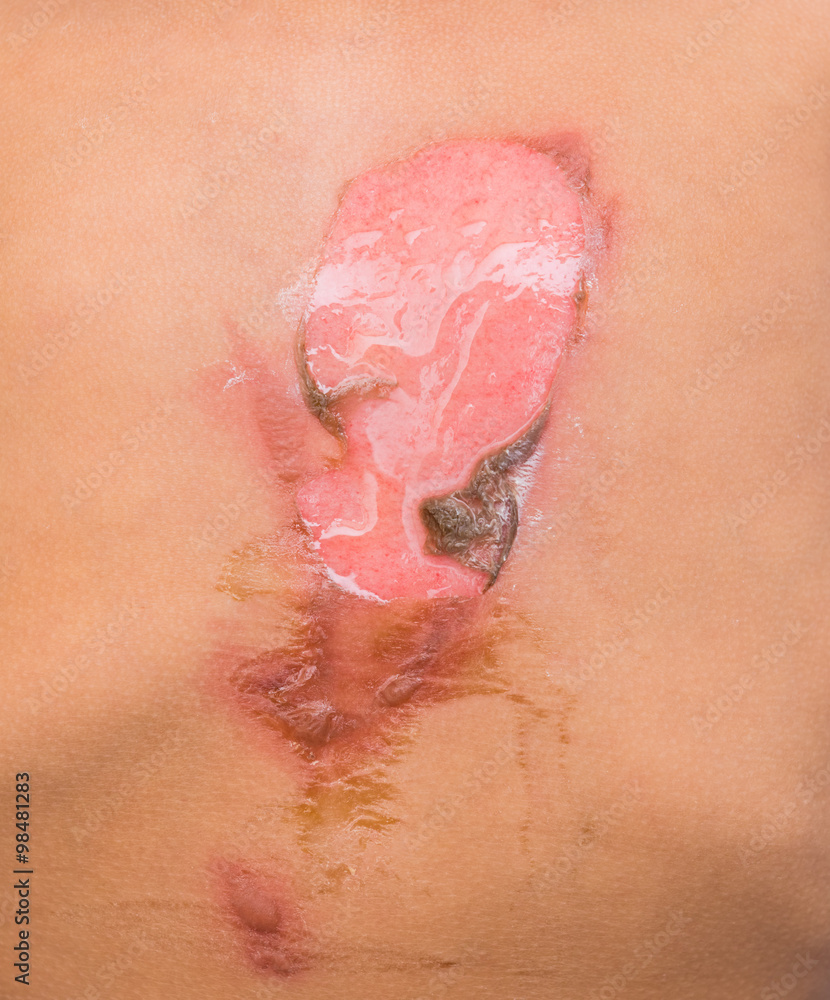 Fototapeta premium close up skin of a child from wounds caused by scalding hot water.(Horrible burns)