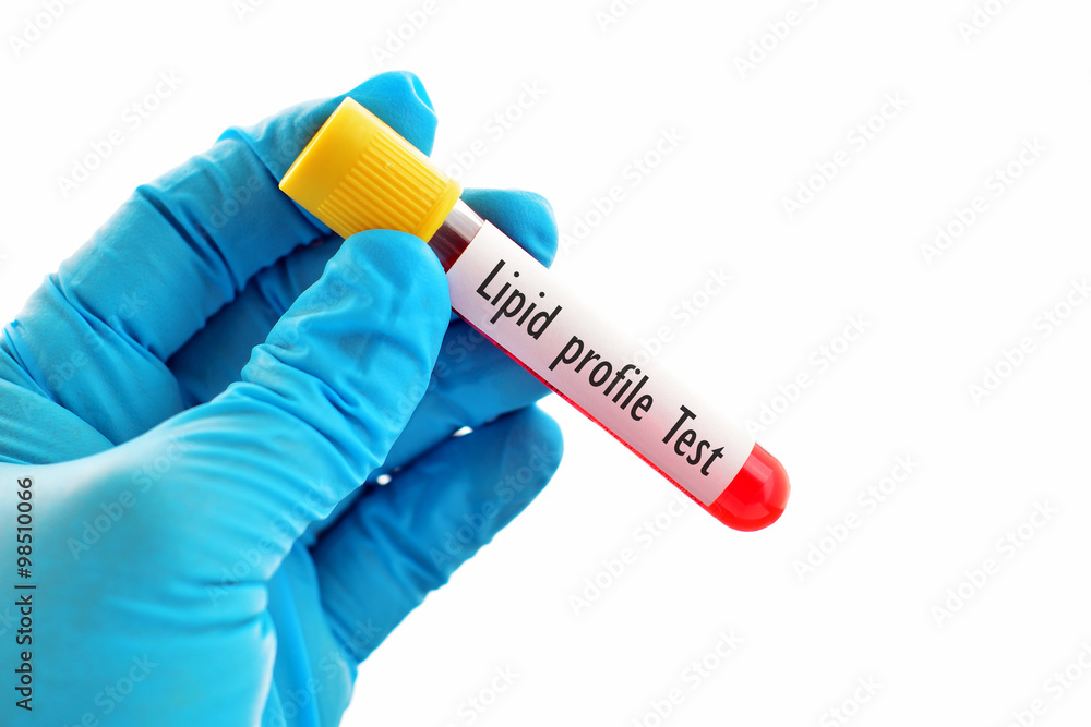 Fototapeta premium Blood for lipid profile test