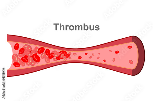 Blood clot in  blood vessel. Diseases of Veins in human body. An