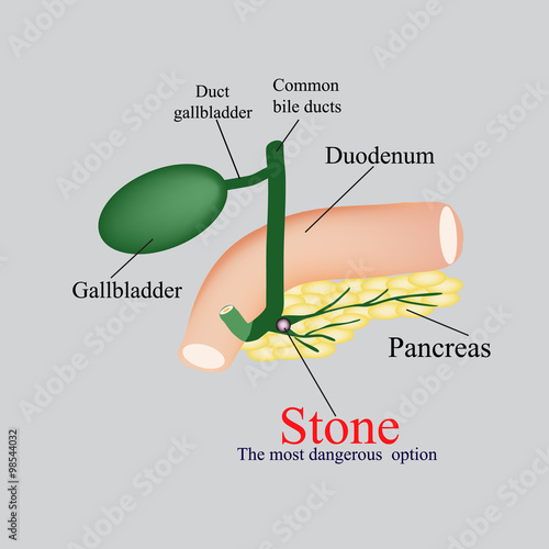 Stone pancreatic bile duct.  The gall bladder, duodenum, bile ducts. Vector illustration on a gray background