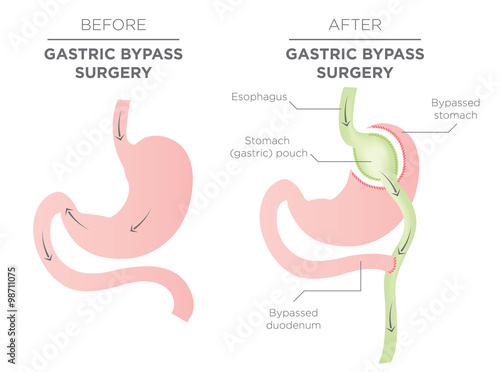 Gastric Bypass for Weight Loss - You Are Actually Re-routing Your Stomach in Order to Feel Full and Eat Less