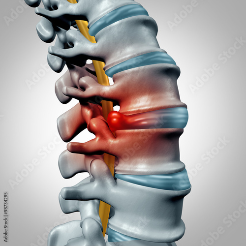 Photos Herniated Disk