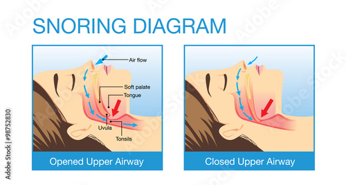 Anatomy of woman while normal sleeping and have snoring. Illustration about health care and medical