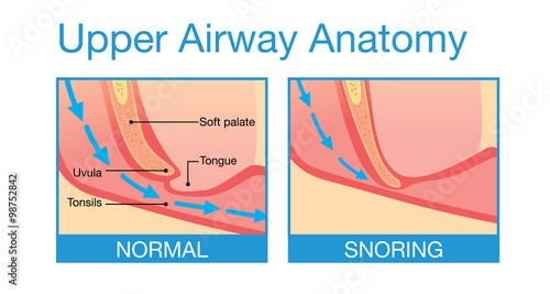 Upper airway human anatomy in normal sleeping and have snoring.