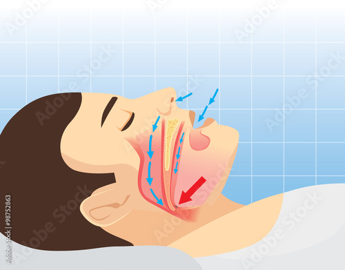Anatomy of man while normal sleeping and have snoring. Illustration about health care and medical
