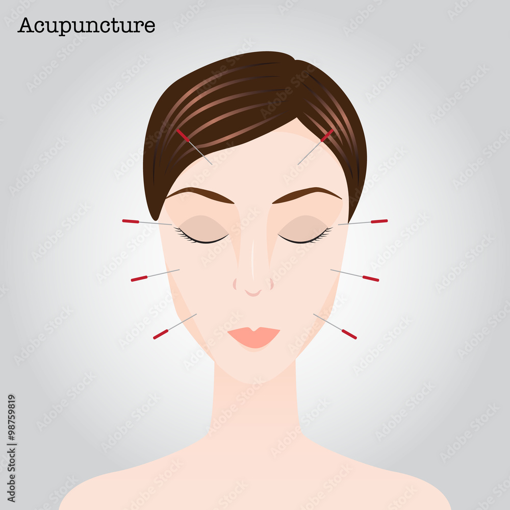Woman getting an acupuncture treatment Woman getting an acupuncture treatment