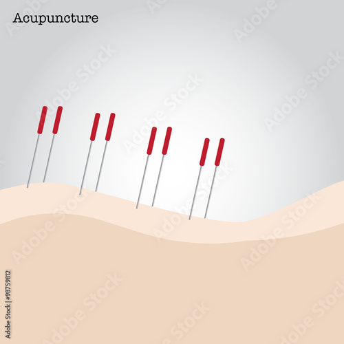 Getting acupuncture treatment.