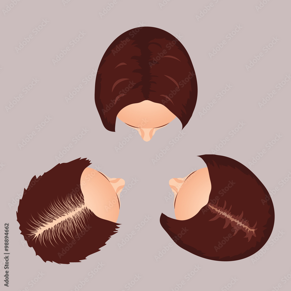 Female hair loss stages set. Top view portrait of a woman losing hair.  Female pattern baldness. Isolated vector illustration. Stock Vector | Adobe  Stock