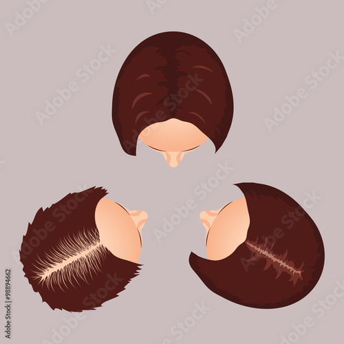 Female hair loss stages set. Top view portrait of a woman losing hair. Female pattern baldness. Isolated vector illustration.