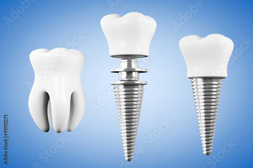 Stomatology concept. Tooth Implant with Tooth