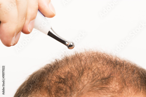 Man with a premature and incipient baldness photo