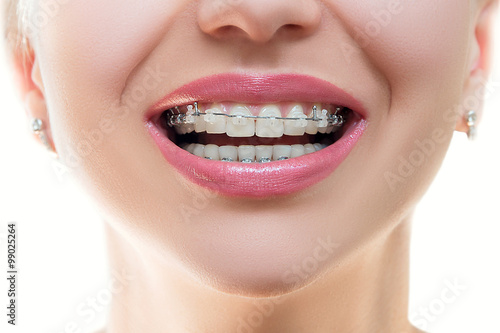 Close up Braces on Teeth. Braces Smile. Orthodontic Treatment. Closeup Smiling Face with Braces. Front view. .