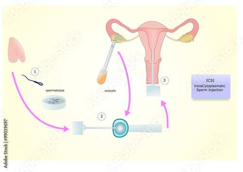Icsi, IntraCytoplasmatic Sperm Injection, una tecnica di inseminazione artificiale o fecondazione assistita contro l'infertilità