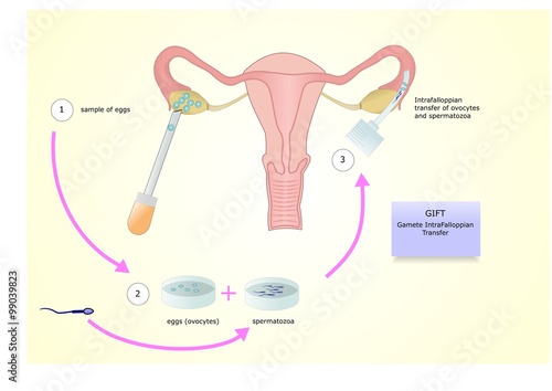 Gift, Gamete IntraFalloppian Transfer, una tecnica di inseminazione artificiale, o fecondazione assistita per trattare l'infertilità