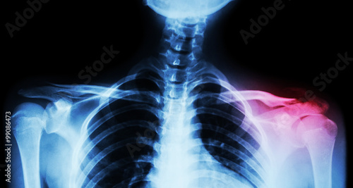 Film x-ray both clavicle AP ( front view ) : show fracture distal left clavicle photo