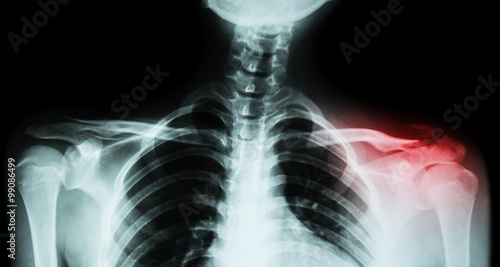 Tableau sur toile Film x-ray both clavicle AP ( front view ) : show fracture distal left clavicle