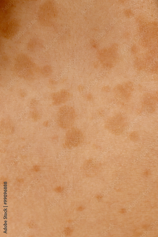Medical: Tinea versicolor is a condition caused by the Malassezia globosa  fungus a form of yeasts. It is characterized by a skin discolor eruption on  the trunk and proximal extremities. Stock Photo