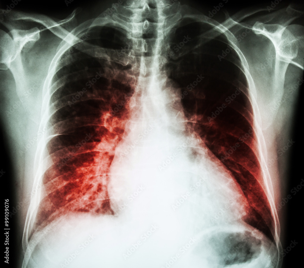 Heart failure ( film x-ray chest PA upright : show cardiomegaly and interstitial infiltrate both lung ) Heart failure ( film x-ray chest PA upright : show cardiomegaly and interstitial infiltrate both lung )
