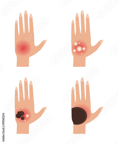 Degree burns. vector Illustration