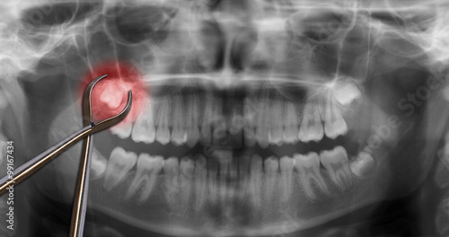 orthodontic tool show wisdom tooth