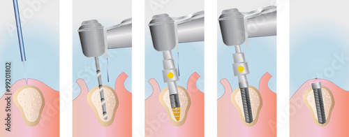 Obraz na płótnie implant surgery medical