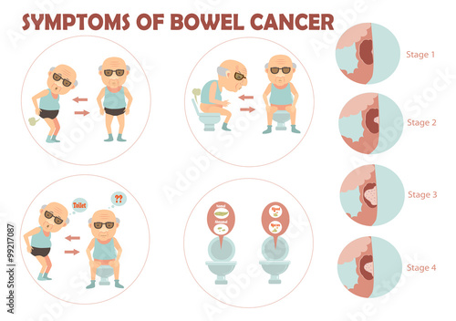 bowel cancer Old man suffered colon cancer and charts the growth of tumors in the colon infographic.Vector illustration