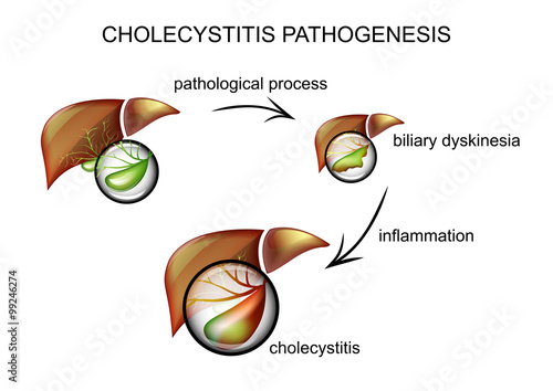 cholecystitis pathogenesis. pathogenesis  photo
