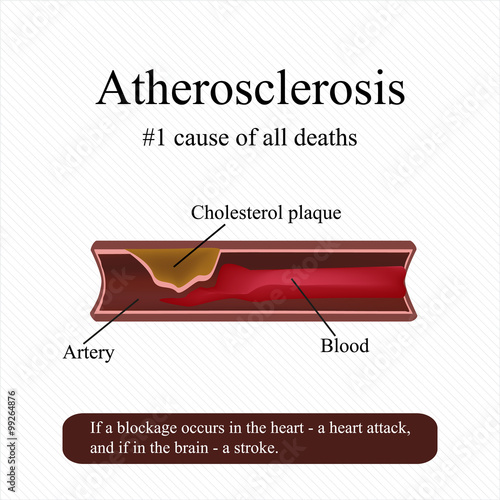 Atherosclerosis. High cholesterol in the blood. Blockage of an artery. Vector illustration