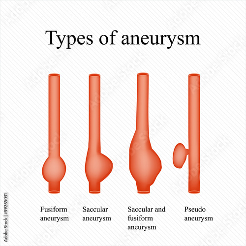 Aneurysm. Types aneurysm. Infographics. Vector illustration