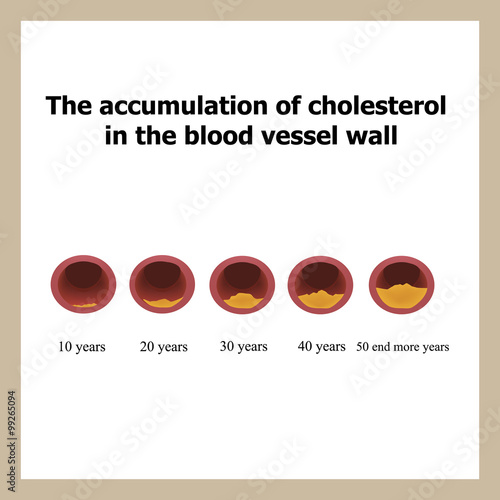 Deposition of cholesterol in function of age. 