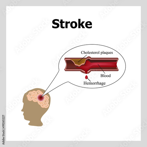 Bleeding in the brain. Insult. Stroke, atherosclerosis. Cholesterol plaques. Infographics. Vector illustration