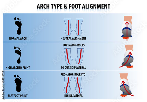 Arch Type and Foot Alignment