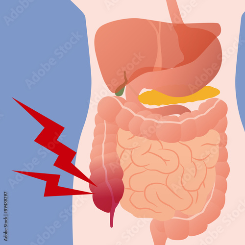 appendicitis and human digestive organs, vector illustration