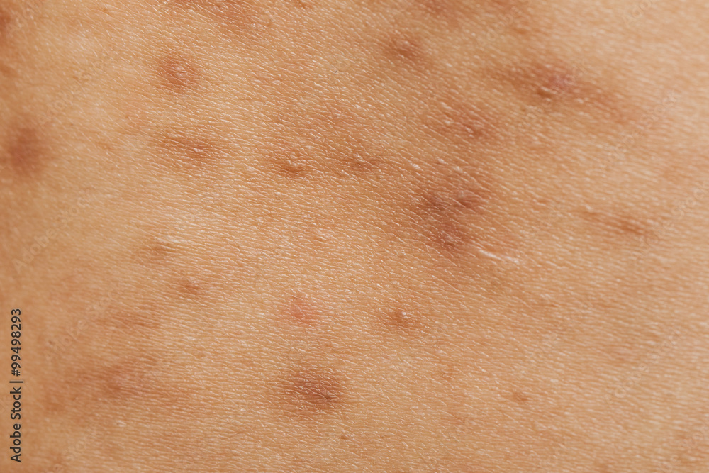Fototapeta premium Boy with problematic skin and acne scars in the back