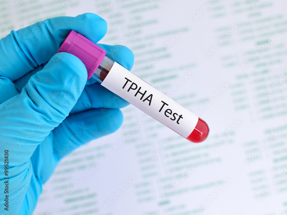 Obraz premium TPHA test (Syphilis disease)