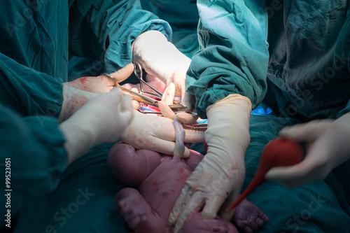 cesarean