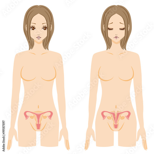 女性　子宮奇形