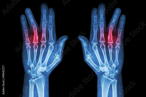 Canvastavla Fracture shaft of proximal phalange of ring finger ( film x-ray both hand AP )