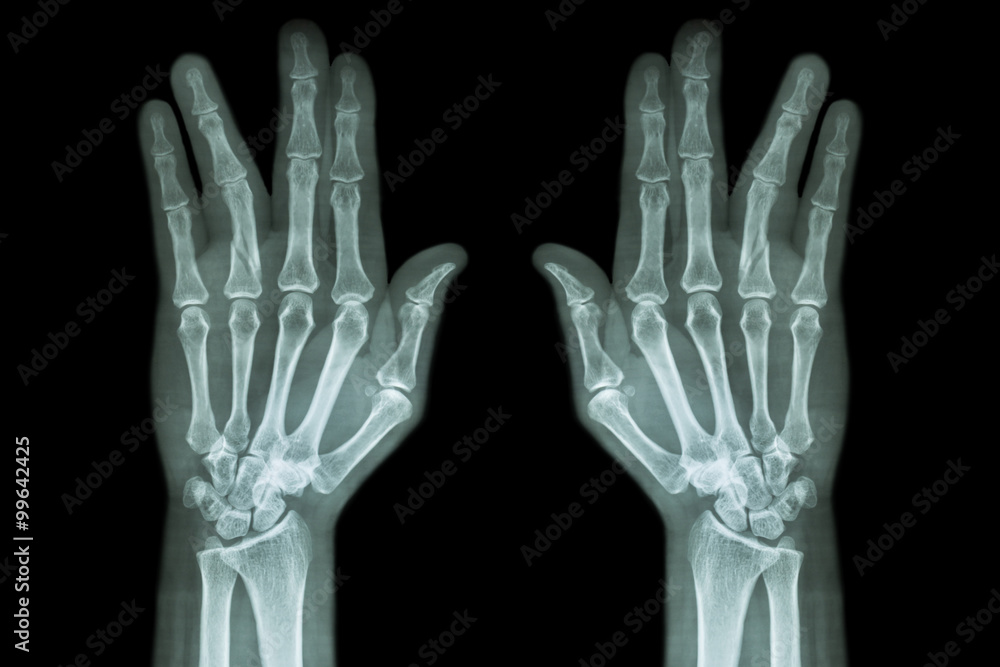 Fracture shaft of proximal phalange of ring finger ( film x-ray both hand AP ) Fracture shaft of proximal phalange of ring finger ( film x-ray both hand AP )