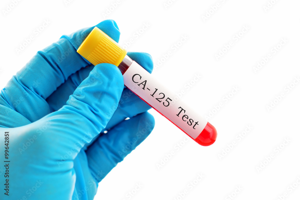 Obraz premium CA-125 test (diagnosis for ovarian cancer)