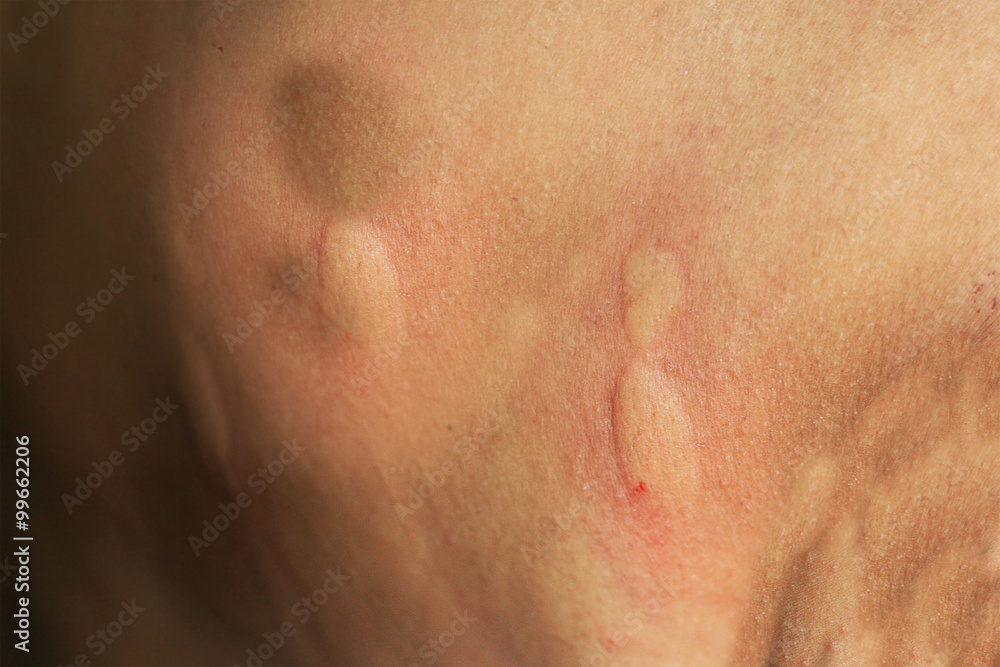 Fototapeta premium Spider bite