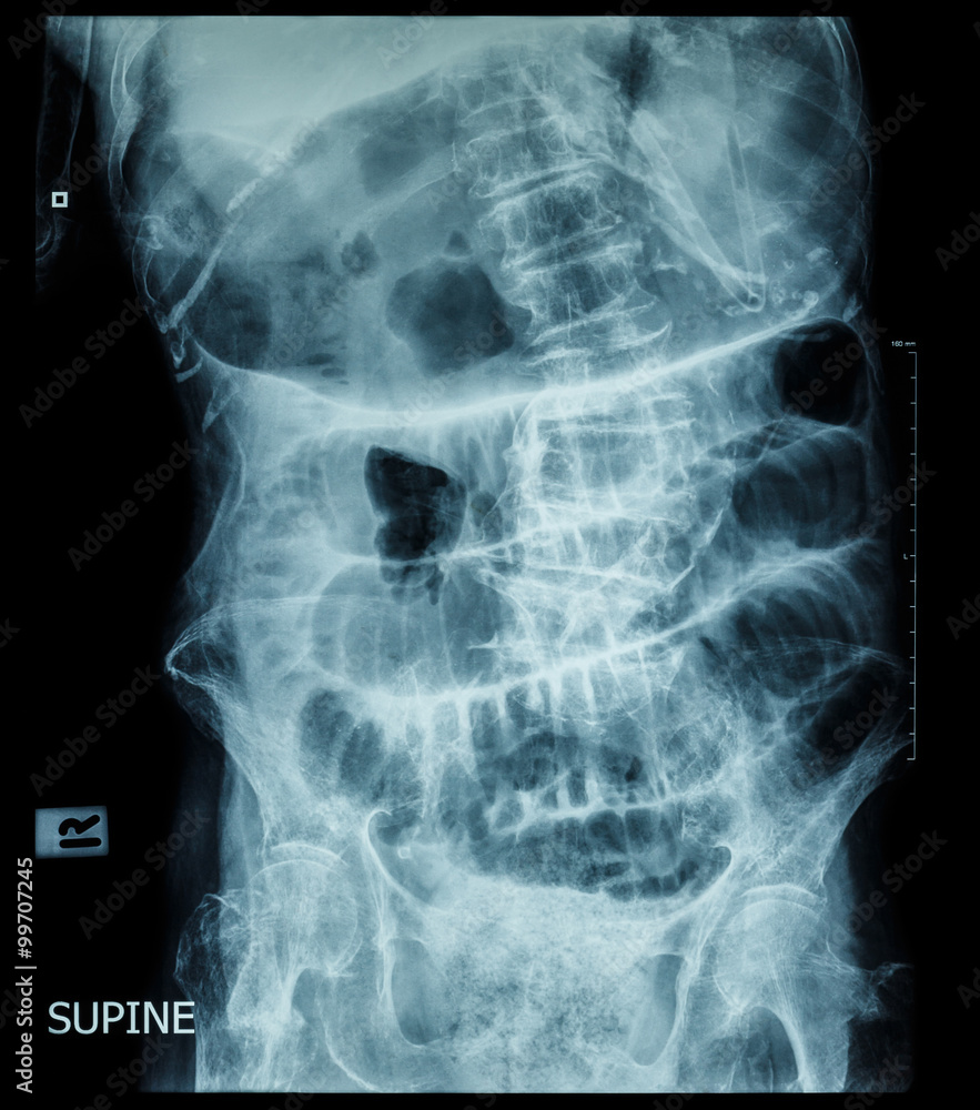 Small bowel obstruction ( film x-ray abdomen ( supine position ) : show small bowel and stomach dilate ) ( step ladder pattern ) Small bowel obstruction ( film x-ray abdomen ( supine position ) : show small bowel and stomach dilate ) ( step ladder pattern )