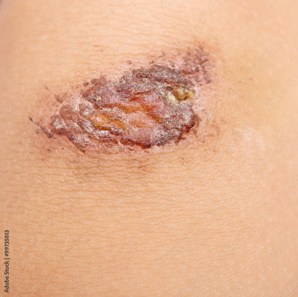 Fototapeta premium wound on skin