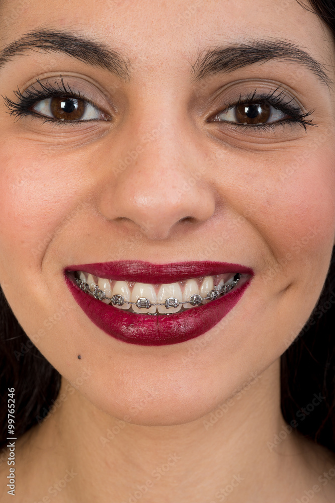 Fototapeta premium portrait of girl with dental braces