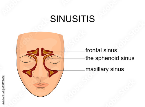 nasal sinus. inflammation