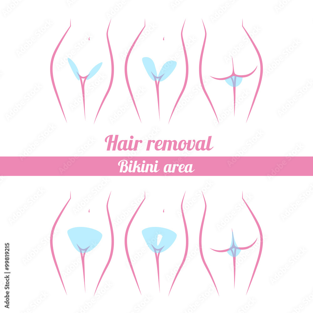 scheme of hair removal bikini area vector de Stock | Adobe Stock